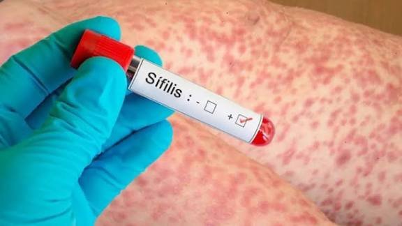 Los casos de sífilis crecieron 38,5% en tres años y alcanzaron un récord en el país
