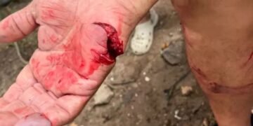 Banda de Varela: Un pitbull atacó a una persona y le dejó heridas graves